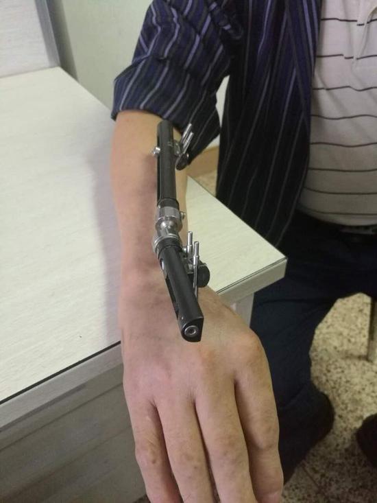 小小海蝦引起險被截肢風波