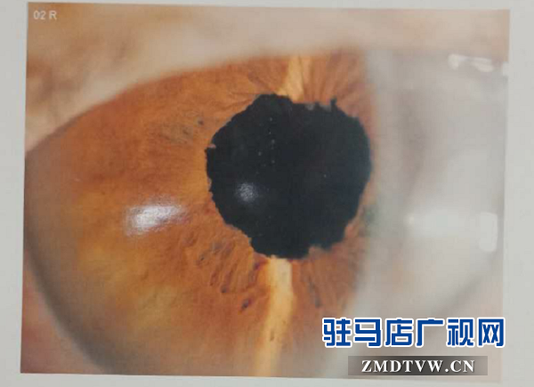 脫貧后，患眼疾20多年重見光明