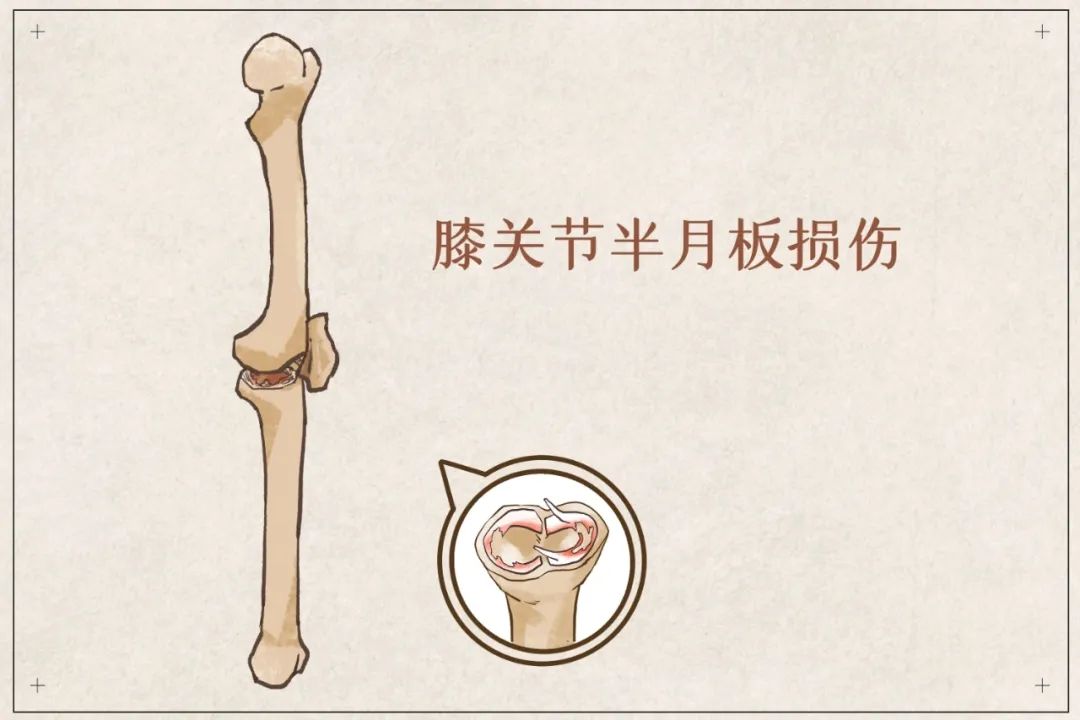 盲目鍛煉？你的半月板傷不起